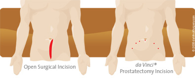 Prostatectomy Incision