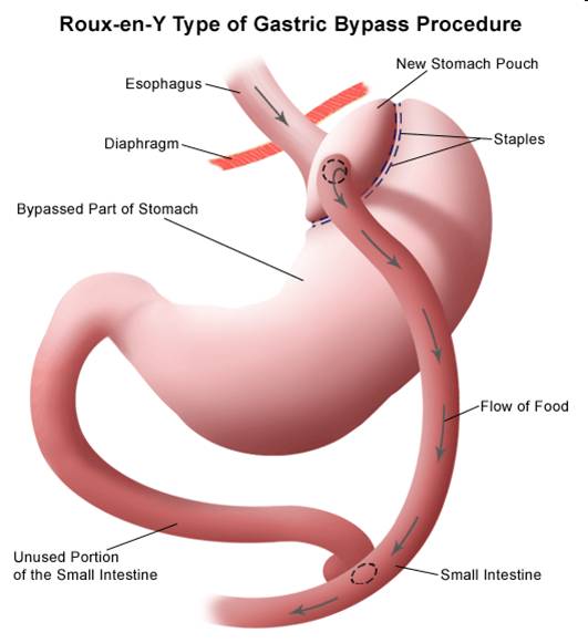 Y-type gastric by-pass